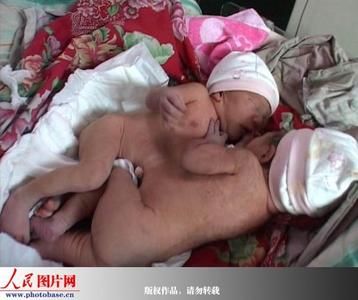 实拍泸州连体男婴医附院成功进行分离手术